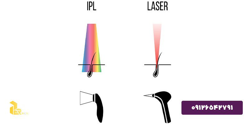 تفاوت های کلی لیزر و IPL
