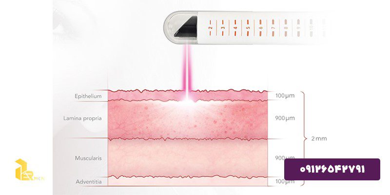 نحوه عملکرد دستگاه لیزر جوانسازی واژن